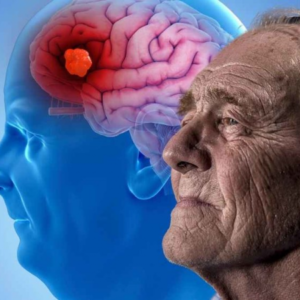 Alzheimer Alzheimer