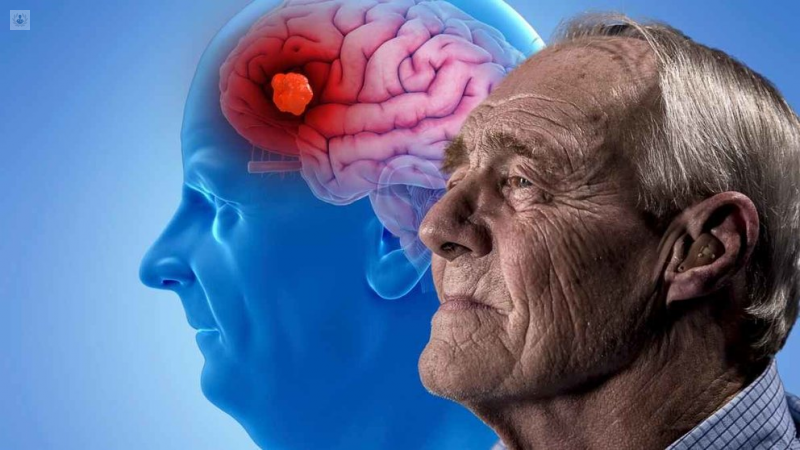 Alzheimer